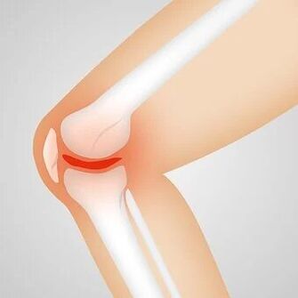 Arthritis is a non-inflammatory joint disease