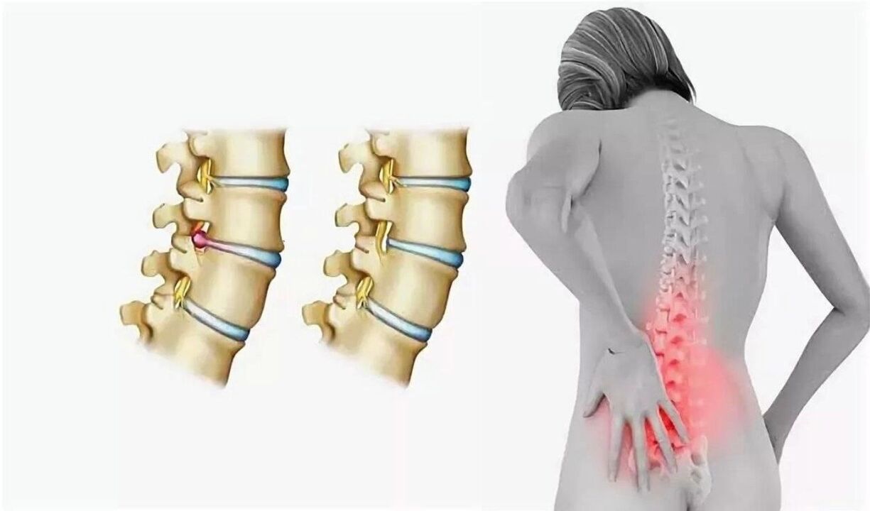 Risks of spinal osteochondrosis