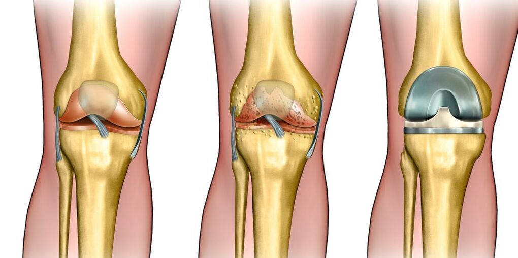 Knee joints